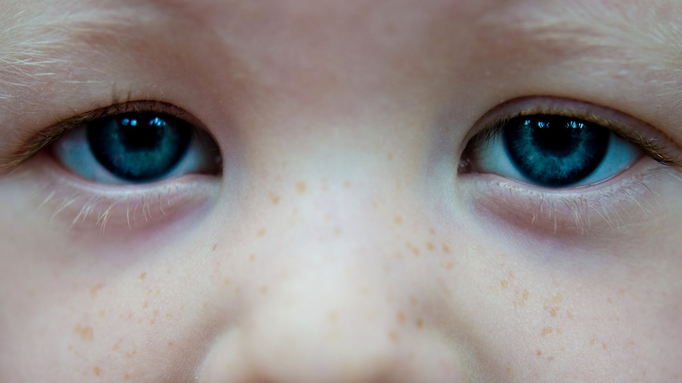 The most common symptom in children with eye cancer is a white reflection in the pupil when photographed with a flash.