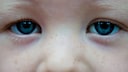 The most common symptom in children with eye cancer is a white reflection in the pupil when photographed with a flash.
