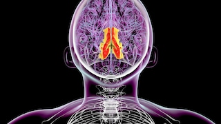 In epilepsy, sudden seizures occur due to excessive activity of nerve cells in the brain.