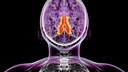 In epilepsy, sudden seizures occur due to excessive activity of nerve cells in the brain.