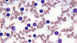 Leukemia Cells in the Blood