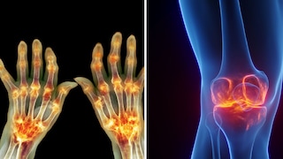 Arthritis and Osteoarthritis: Key Differences Explained

An overview of causes, symptoms, and common complaints.