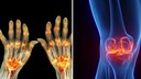 Arthritis and Osteoarthritis: Key Differences Explained

An overview of causes, symptoms, and common complaints.