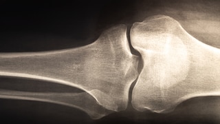 How Are Bone Health and Mental Well-being Connected?