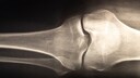 How Are Bone Health and Mental Well-being Connected?