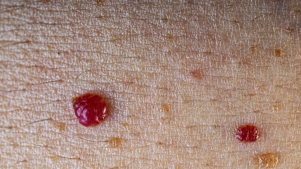 "Ruby Spots" on the Skin