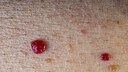 "Ruby Spots" on the Skin