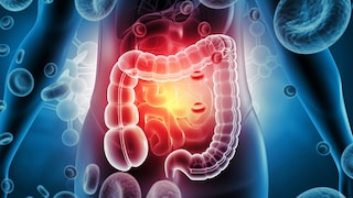 Colorectal Cancer Increasingly Affects Younger Adults