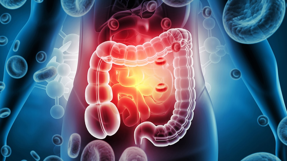 Colorectal Cancer Increasingly Affects Younger Adults