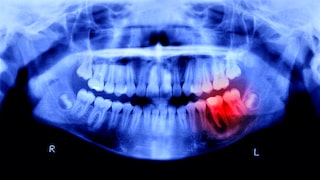 Periodontitis: Fasting Mimicking Diet May Reduce Inflammation