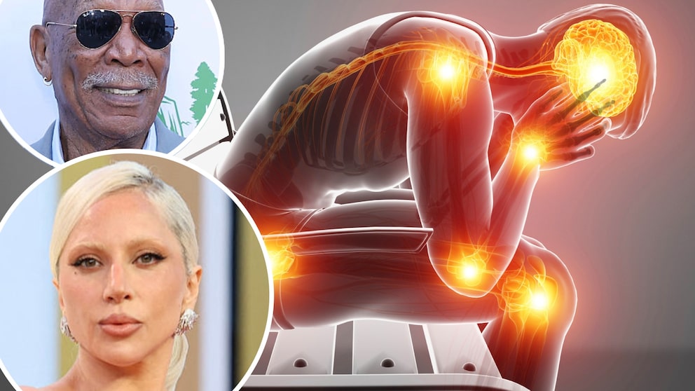 Fibromyalgia