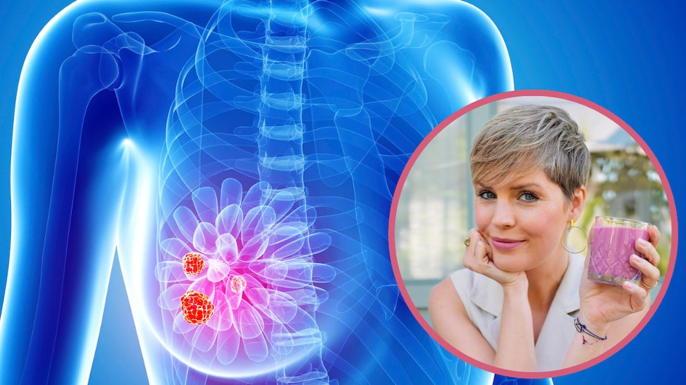 Carolin Kotke Breast Cancer