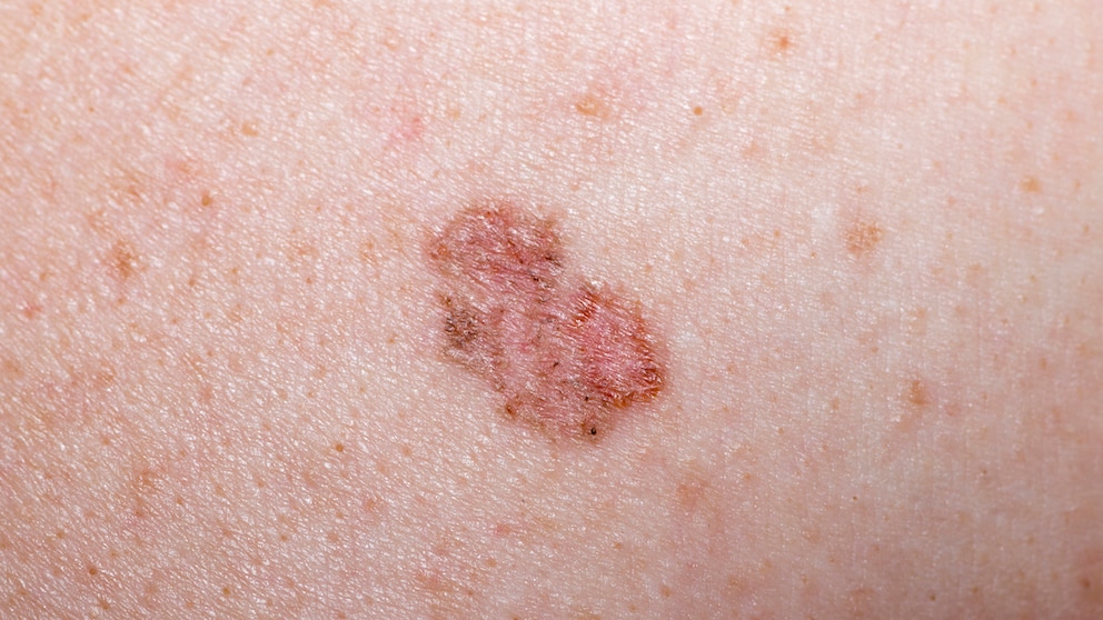 There are two types of skin cancer: melanoma and non-melanoma. Which is more dangerous?