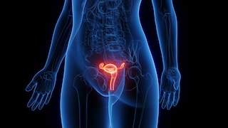 Endometriosis
