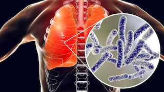 Legionella cases increase in the summer, and in Switzerland, someone has even died from it again.