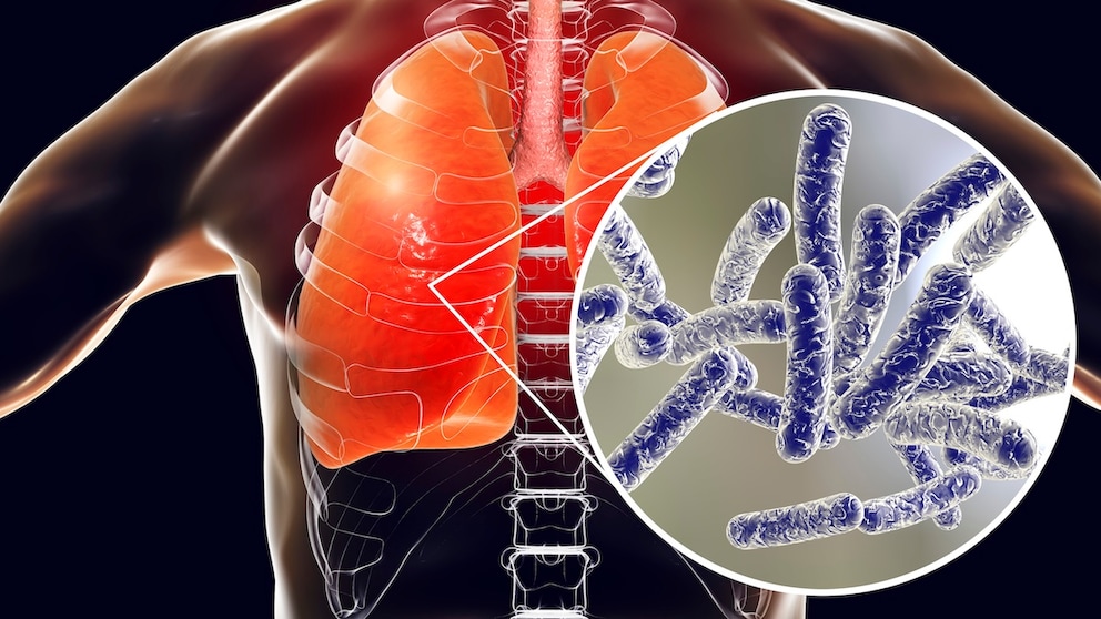 Legionella cases increase in the summer, and in Switzerland, someone has even died from it again.