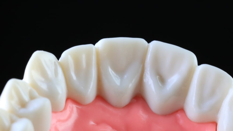 Periodontitis is being studied in connection with Alzheimer's
