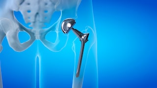 Artificial hips and knees can release tiny particles. U.S. researchers are now investigating whether these particles can reach the brain.