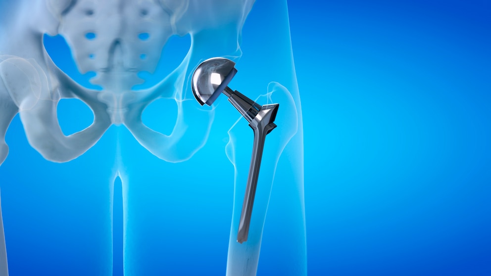 Artificial hips and knees can release tiny particles. U.S. researchers are now investigating whether these particles can reach the brain.