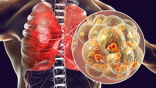 The insidious nature of pneumonia is that its symptoms can vary depending on the pathogen and the individual's health condition.
