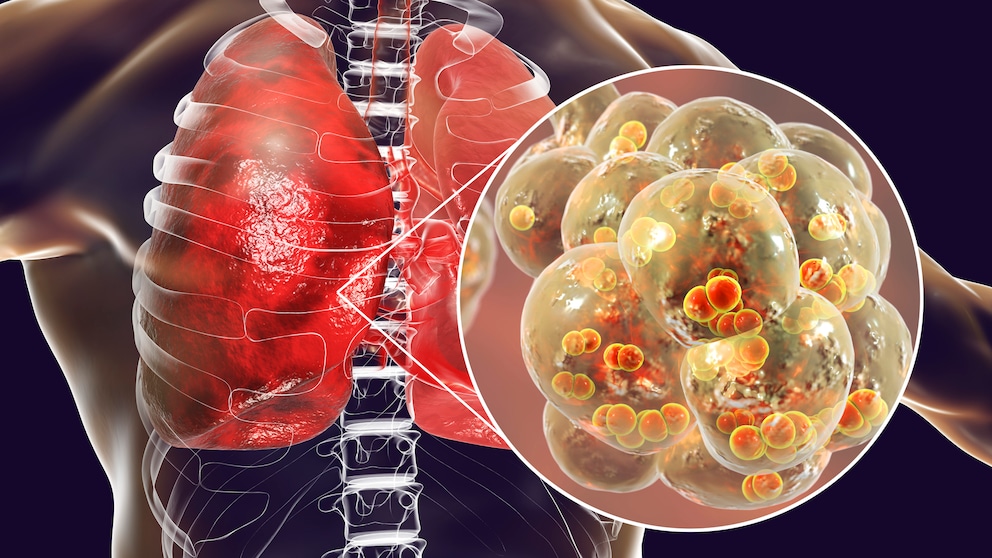 The insidious nature of pneumonia is that its symptoms can vary depending on the pathogen and the individual's health condition.