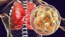 The insidious nature of pneumonia is that its symptoms can vary depending on the pathogen and the individual's health condition.