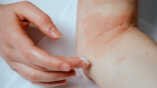 Eczema and Itching: Neurodermatitis Can Cause Significant Distress