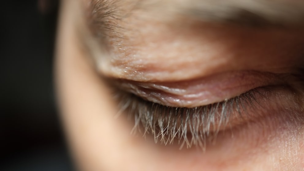 Droopy eyelids can, among other things, contribute to migraines.