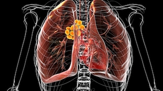 Lung nodules can be cancerous, but they are usually harmless.