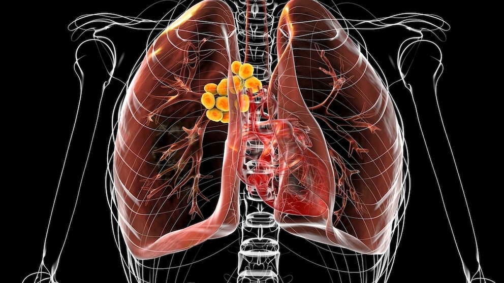 Lung nodules can be cancerous, but they are usually harmless.