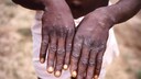Hands of a patient suffering from Mpox