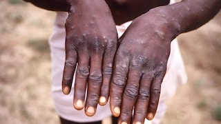 Hands of a patient suffering from Mpox